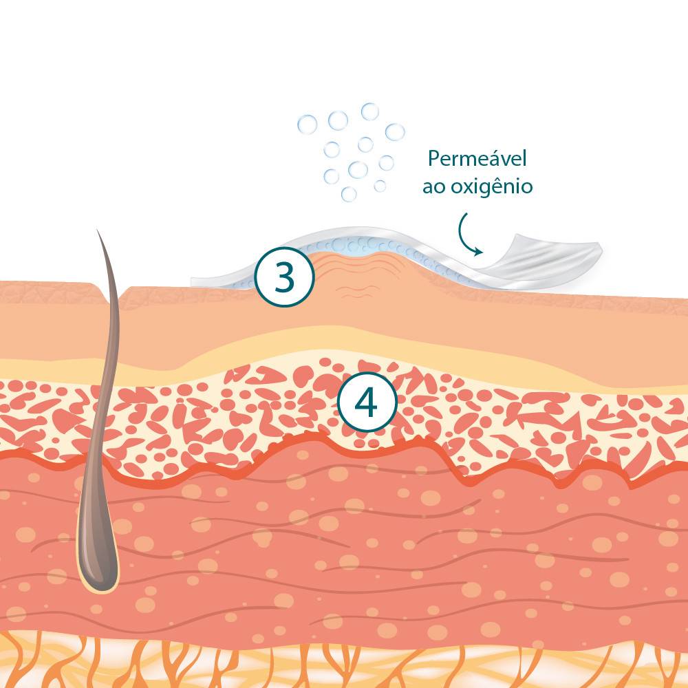 Scar Treatment Mechanism of Action 2nd stage